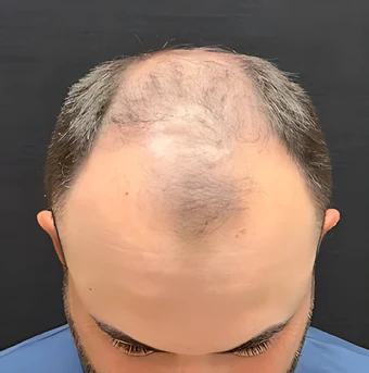 Transplante capilar — etapa 1: Primeira consulta