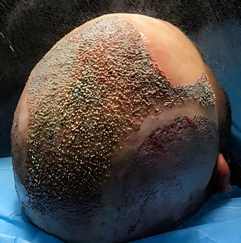 Transplante capilar — etapa 4: Dia da cirurgia